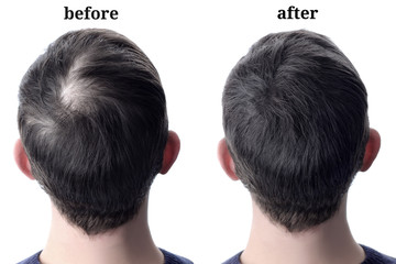 Men'shair after using cosmetic powder for hair thickening. Before and after