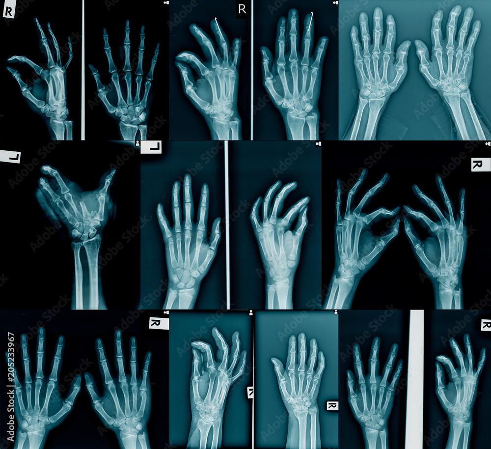 Canvas Prints collection x-ray of hand