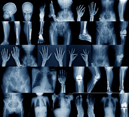 collection x-ray image skull, shoulder, hip, knee joint , scoliosis spinne and small joint in...