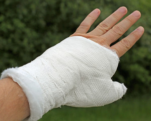 broken hand with the white medical cast after the fracture of th