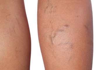 Spider veins close up.Varicose veins.