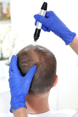Mezoterapia igłowa skóry głowy.  Głowa mężczyzny z przerzedzonymi włosami podczas zabiegu mezoterapii igłowej