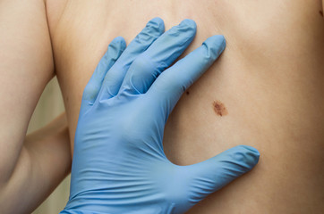 the doctor examines the birthmark on the back
