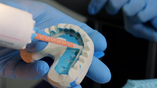 Establishment of plastic temporary plate for future veneers. Dentist lubricates the 3d jaw with dental glue. Cosmetic Dentistry, medicine, stomatology concept. Close up view