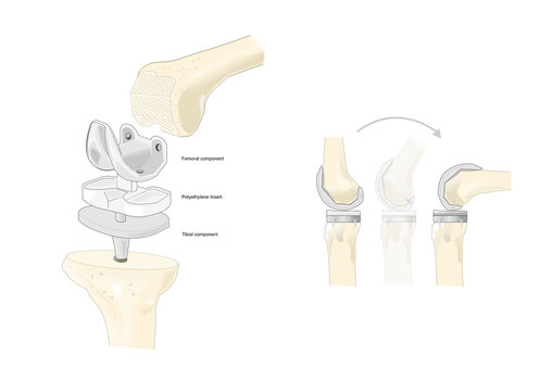 model of an artificial knee prosthesis and its parts