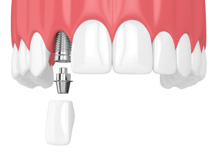 3d render of upper jaw with teeth and dental lateral incisor implant © Aleksandra Gigowska