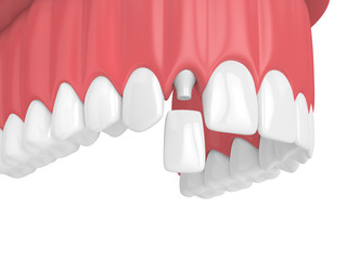 3d render of upper jaw with teeth and dental lateral incisor crown © Aleksandra Gigowska