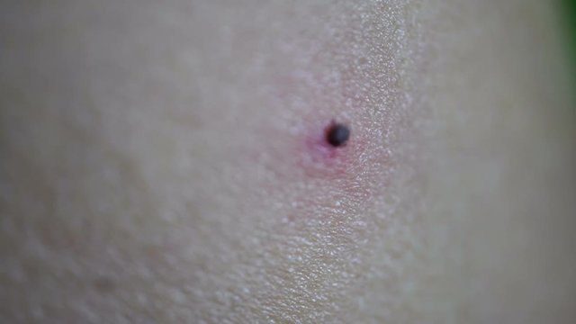 Tick Fastened to Human Skin Feeding on Blood