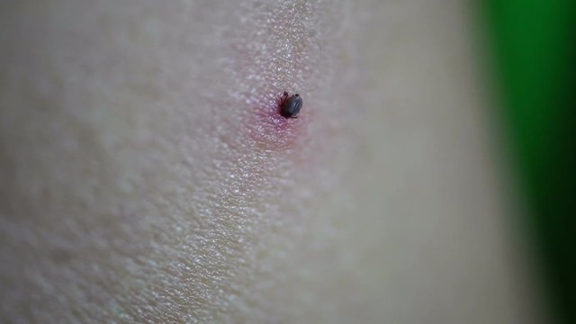 Tick Fastened to Human Skin Feeding on Blood