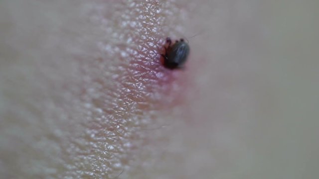 Tick Fastened to Human Skin Feeding on Blood