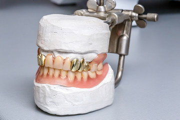 Dental gold teeth prosthesis, clay mold human gums model