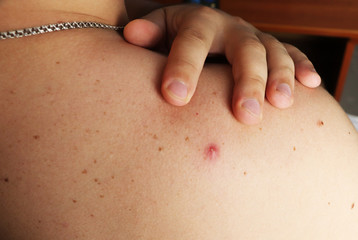 Fototapeta premium Photo of a pimple with pus on the back of a man