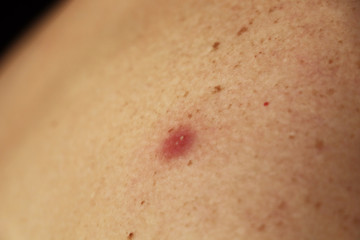 Fototapeta premium Photo of a pimple with pus on the back of a man