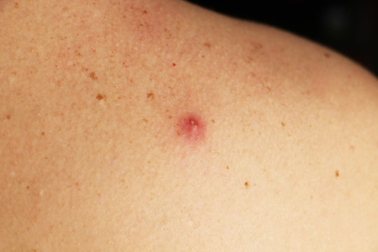 Photo of a pimple with pus on the back of a man