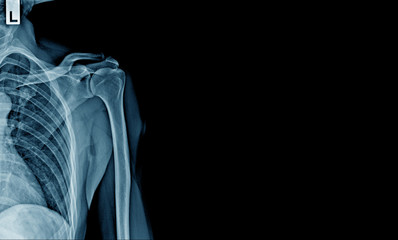 x-ray shoulder and part of rib and lung, banner x-ray