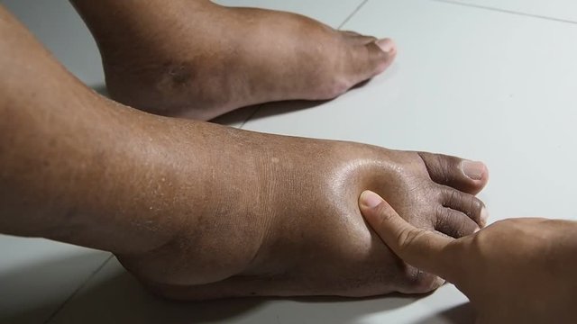 The feet of people with diabetes, dull and swollen. Due to the toxicity of diabetes placed on a white background. Fingers hit the back of the diabetic foot. To test foot swelling.
