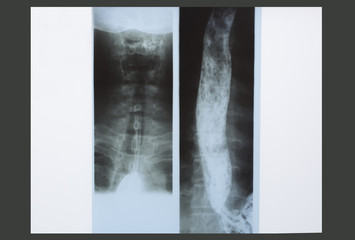 Esophagus x-ray on an illuminated panel