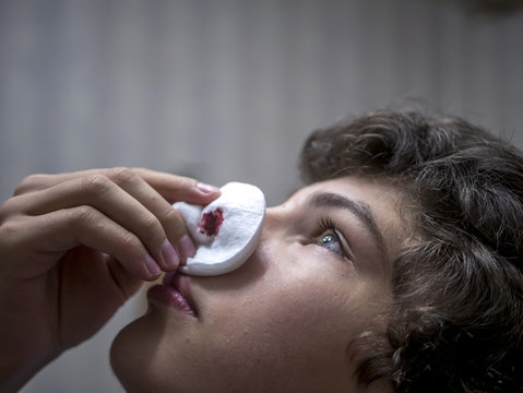 close up face of teenager with bleeding blood from nose