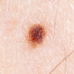 Fototapeta premium Melanoma on the human skin as a background