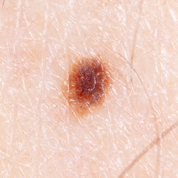 Melanoma On The Human Skin As A Background