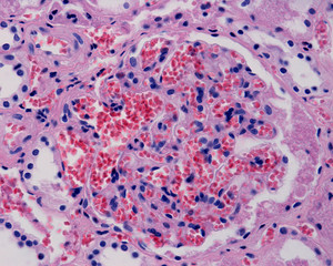 Glomerular congestion