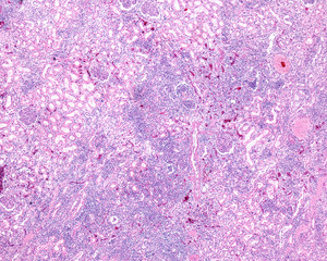 Kidney. Chronic pyelonephritis
