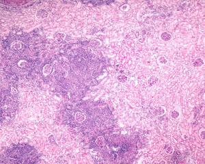 Kidney. Chronic pyelonephritis