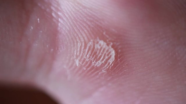 Callosity on man's palm extreme close up