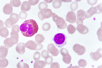 White blood cells in blood smear, analyze by microscope

