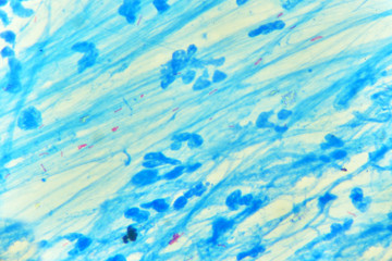 Fototapeta na wymiar Mycobacterium positive (small red rod) in acid fast stain sputum, specimen from tuberculosis patient, analyze by microscope 