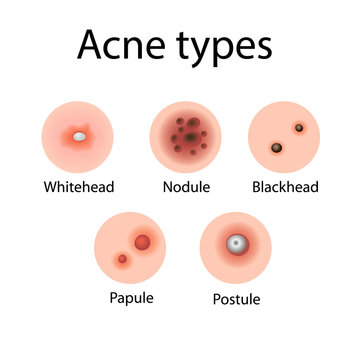 Acne types vector illustration. Cosmetology. Derma problems