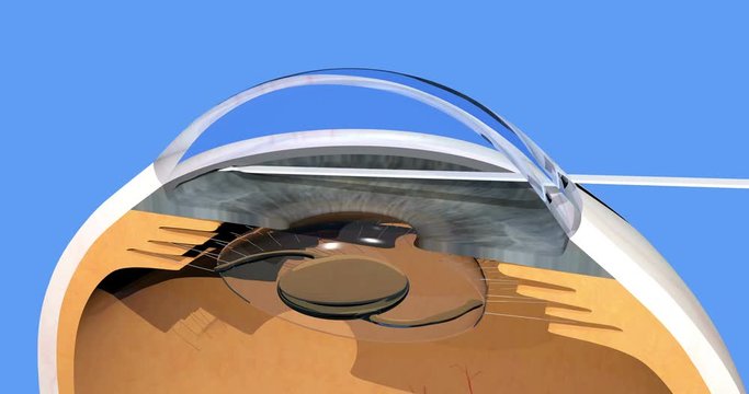 glaucoma surgery, reestablished natural aqueous humor outflow in human eye after ab interno trabeculotomy, 4K, 3d render, cg animation on blue background