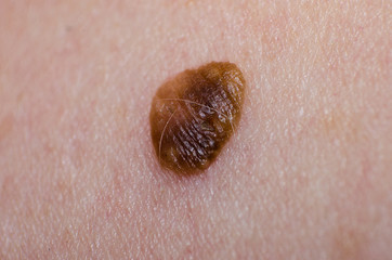 Birthmark or papilloma or Keratopapilloma on human skin closeup