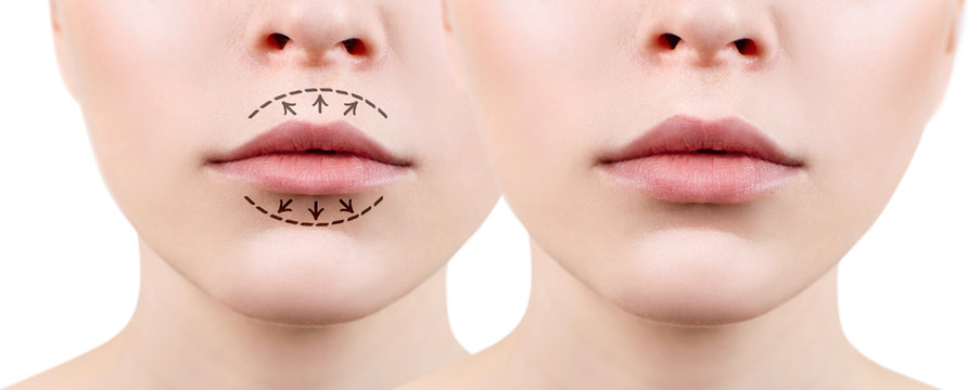 Lips of young woman before and after augmentation