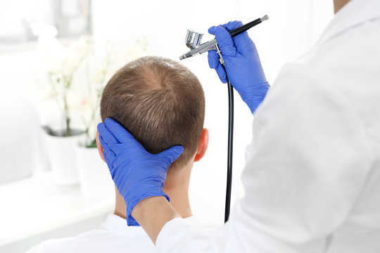 
Oxybrazja tlenowa sk&oacute;ry głowy.
 Głowa mężczyzny z przerzedzonymi włosami podczas zabiegu pielęgnacyjnego