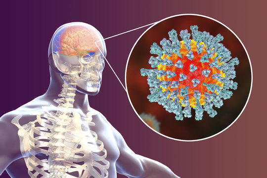 Measles-induced encephalitis, medical concept, 3D illustration showing brain infection and close-up view of Measles viruses