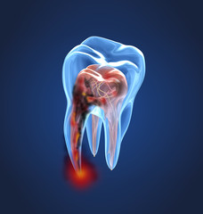Damaged teeth xray view. Medically accurate tooth 3D illustration - obrazy, fototapety, plakaty