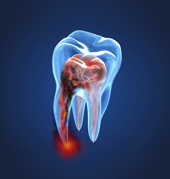 Damaged teeth xray view. Medically accurate tooth 3D illustration