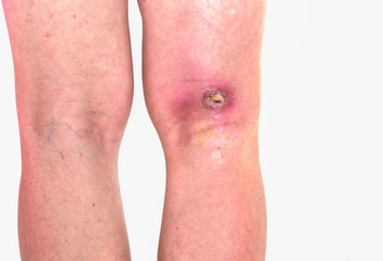 abcess popiteal area, inflammation of popiteal zone at right leg, infected wound righ knee bent