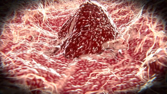 Wandernde Krebszelle. Krebszellen k&ouml;nnen von einem Tumor zu anderen Geweben wandern und Metastasen bilden.