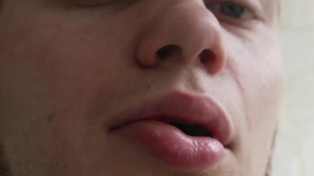 angioedema. Allergic reaction to the lip. Hives