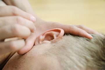 Ear acupuncture treatment.