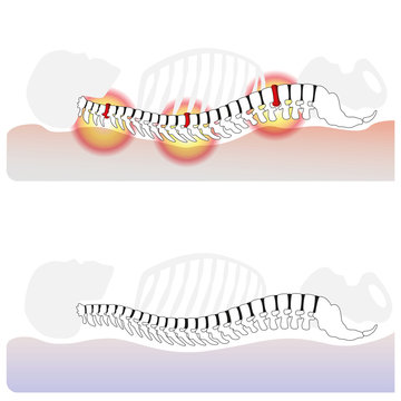 Correct Reclining And Sleeping On The Right Mattress Versus Sleep Problems, Back Pain, Neck Aches And No Recovery Factor Because Of To Hard Or To Soft Mattresses. Profile View Of Spine Column.