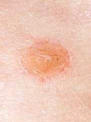 Ringworm on the human skin as a background