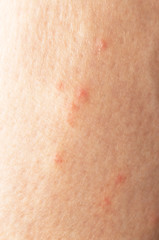 Fototapeta premium mosquito bites on the leg