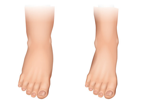 Vector illustration of edema on feet. 
Swelling of the feet and ankles.