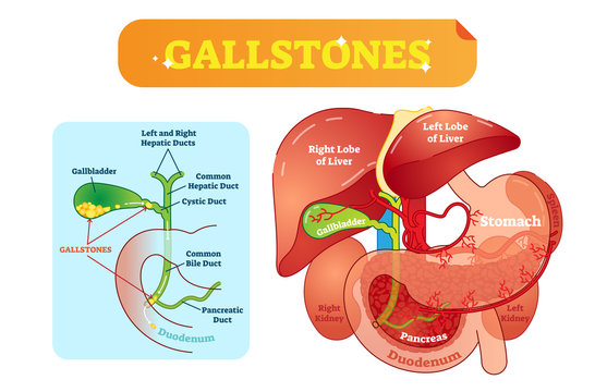 Gallstones Anatomical Cross Section Vector Illustration Diagram With Abdominal Cavity And Gallbladder, Bile Ducts And Duodenum.