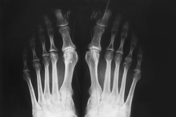 X-ray of the foot, valgus deformity of the toe