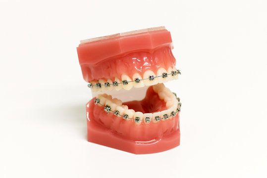 Dental Model With Orthodontic Appliance