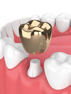 3d render of teeth with dental golden crown filling